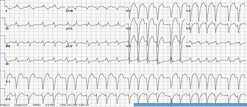 ECG of the Month: A 76-Year-Old Woman Presents with Frequent PVC